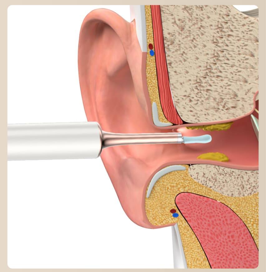 odstraňovač ušného mazu cistenie usi usha