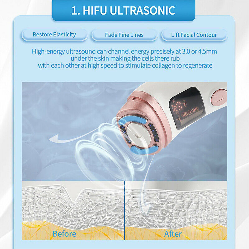 hifu ultrazvuk